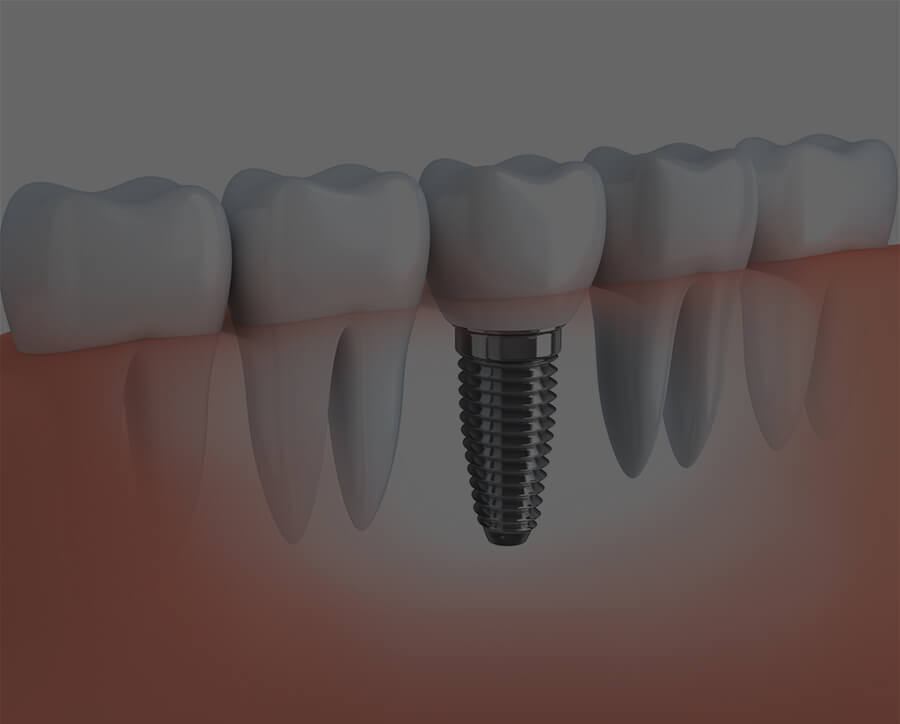 feature dental implants
